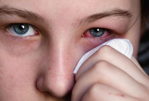 Caracterização da conjuntivite alérgica em crianças