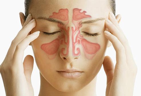 O que é Sinusite, suas causas e sintomas